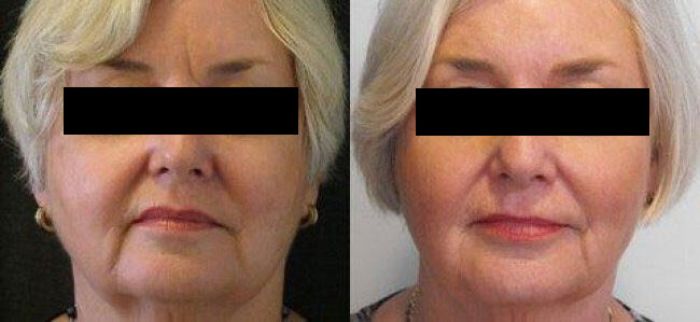 Stubborn frown line treated with fillers