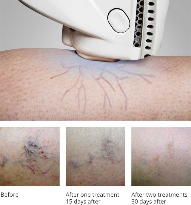 Spider Veins Before and After Exotherme Laser